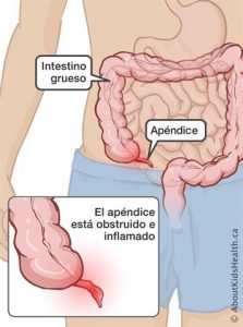 apendicitis