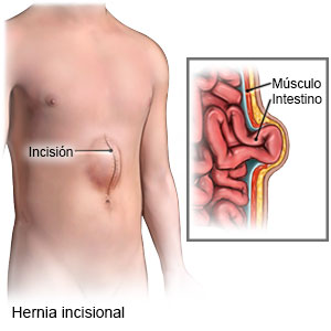 Hernia Insicional