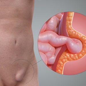 Cirugía de Hernia Inguinal