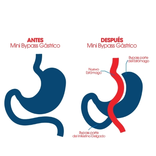 Cirugía de Mini Bypass Gástrico