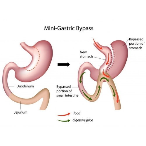 Mini Bypass Gástrico